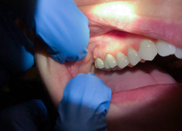 Best Emergency Wisdom Teeth Removal in Cotati, CA